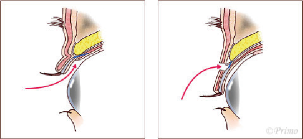 眼瞼下垂手術イラスト